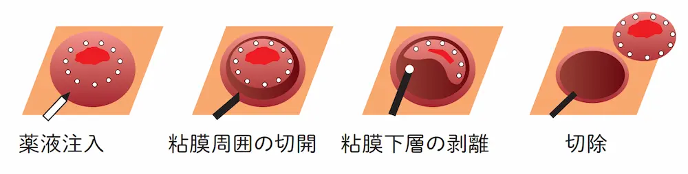 内視鏡的粘膜下層剥離術（ESD）