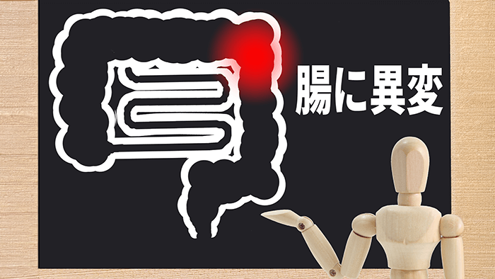 大腸がんの原因｜食事・生活習慣・家族歴との関係をわかりやすく解説