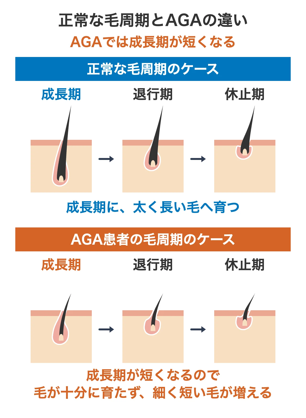 正常な毛周期とAGAの違い