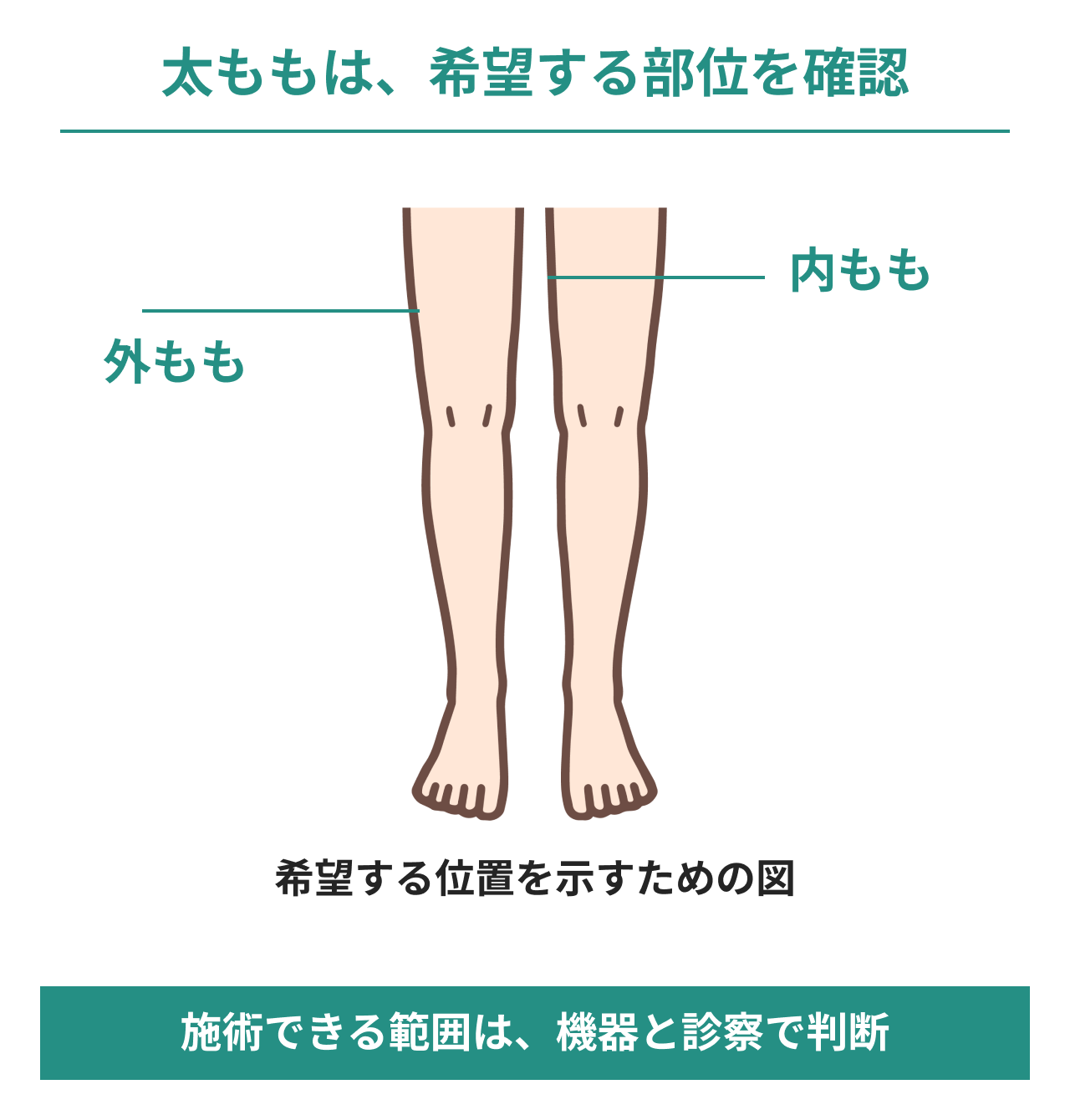 太もものどの部位を希望するかを、脚の前面イラストの内もも・外ももへの位置線で示した図。希望位置を伝えるための図であり、施術できる範囲は機器と診察で判断することを説明。