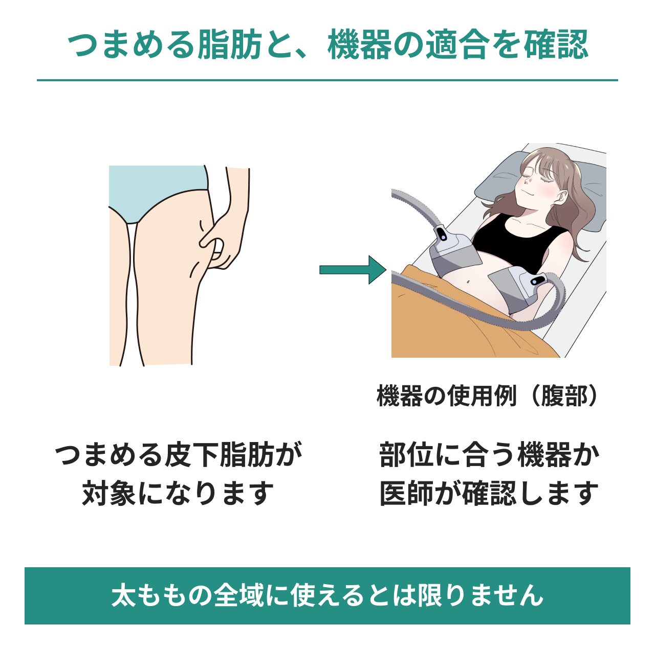 太もものつまめる皮下脂肪と機器の適合を確認する図。太ももの脂肪をつまむイラストから冷却機器の使用例へつなぎ、対象の脂肪と部位に合う機器かを医師が確認すること、太ももの全域に使えるとは限らないことを説明。機器のイラストは腹部への使用例。