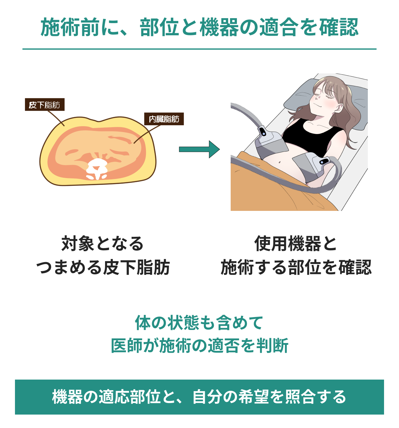 脂肪冷却の前に部位と機器の適合を確認する図。腹部断面の皮下脂肪から冷却機器による施術へつなぎ、対象のつまめる皮下脂肪、使用機器と施術部位、体の状態を医師と確認して適否を判断することを示す。