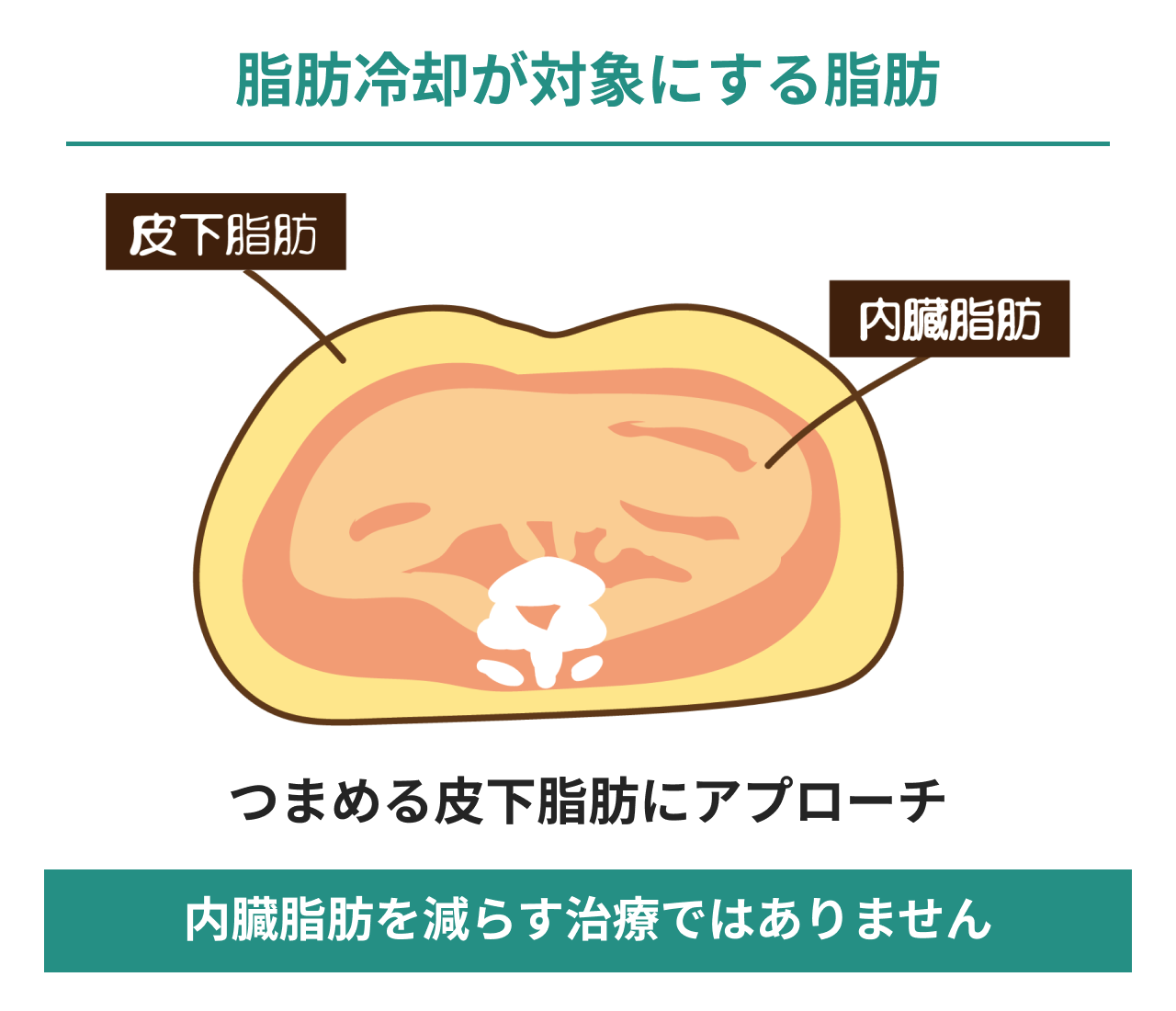 脂肪冷却の対象はつまめる皮下脂肪で、内臓脂肪を減らす治療ではないことを腹部断面で示した図。