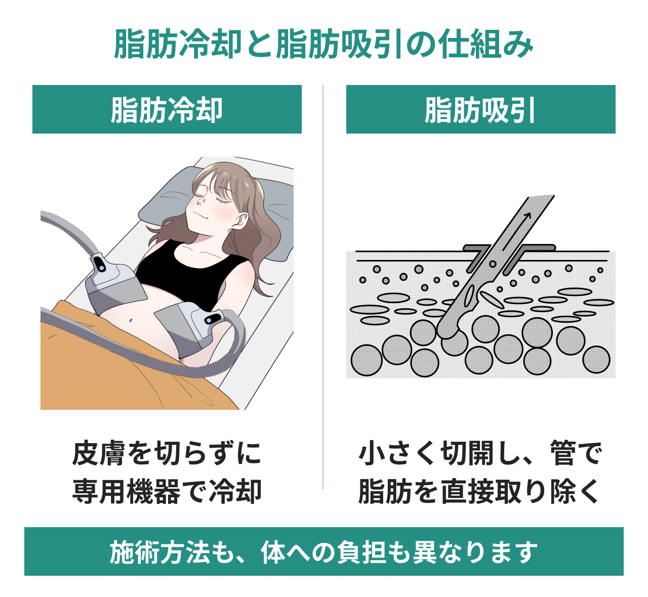 脂肪冷却は皮膚を切らずに専用機器で冷却し、脂肪吸引は小さく切開して管で脂肪を直接取り除くという仕組みの比較図。