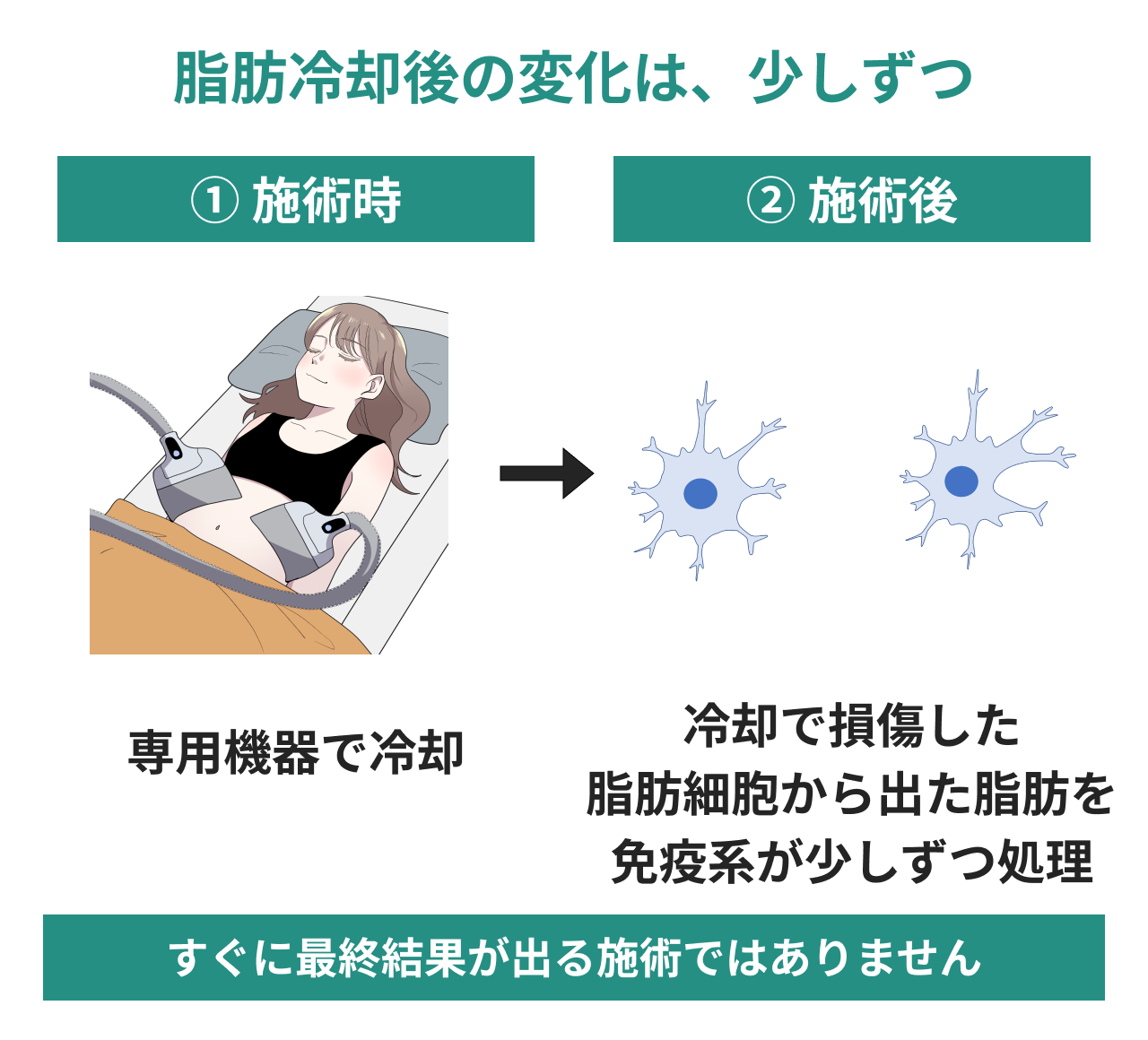 冷却で損傷した脂肪細胞から出た脂肪を、体内の免疫系が少しずつ処理する流れ。施術イラストと免疫細胞の模式図で、すぐに最終結果が出る施術ではないことを説明。