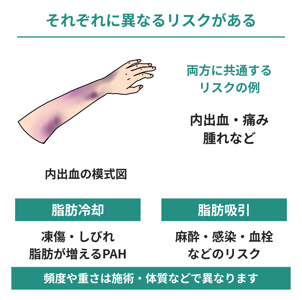 内出血の模式図と、脂肪冷却・脂肪吸引のリスク比較。共通する内出血・痛み・腫れ、冷却の凍傷・しびれ・脂肪が増えるPAH、吸引の麻酔・感染・血栓を示し、頻度や重さは施術・体質などで異なると説明。
